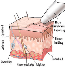 microdermbrasie-huid